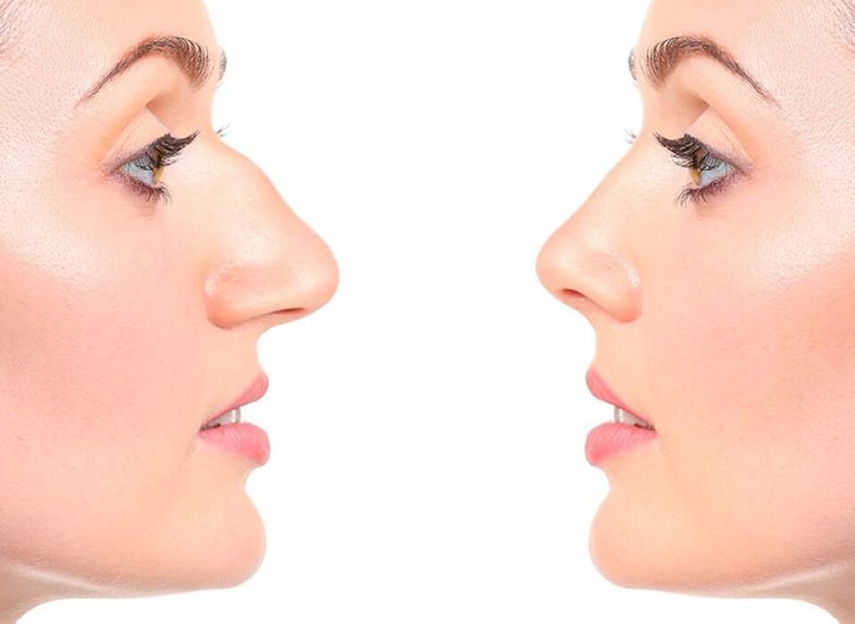 Rhinoplasty