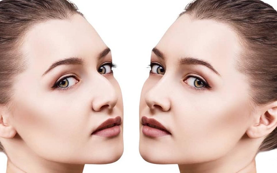 Different Types of Rhinoplasty