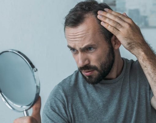 What are The Male Pattern Baldness Stages
