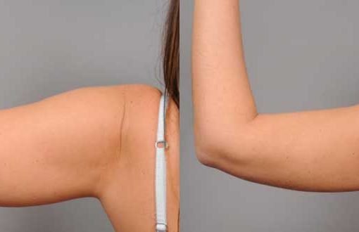 Benefits-Of-Smart-Lipo