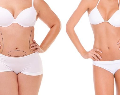 Abdominoplasty