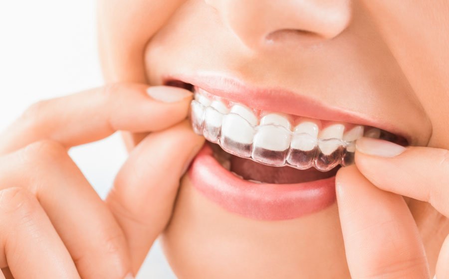 How Long Does Invisalign Take to Straighten Teeth