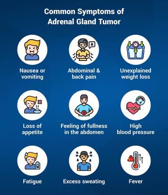 Everything You Need To Know About Adrenal Gland Tumor