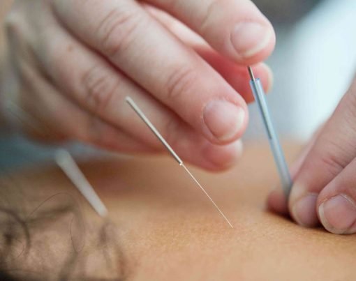 First Acupuncture Session