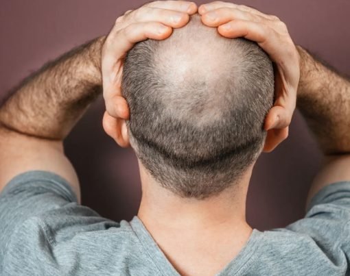 Why Are Men So Prone to Male Pattern Baldness and What Can Be Done About It