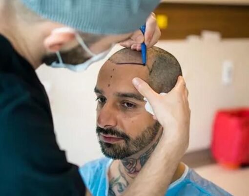 Hair transplantation in the UK