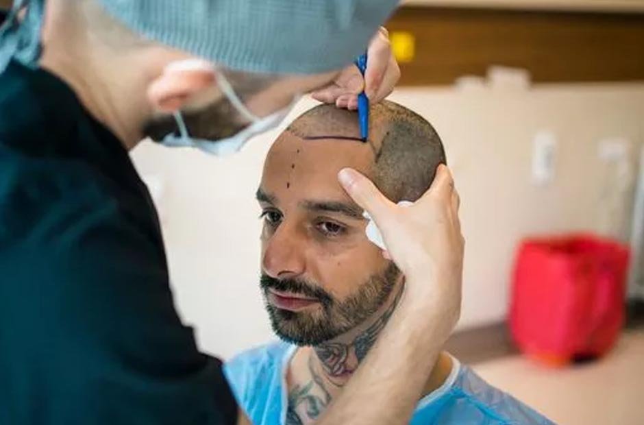 Hair transplantation in the UK