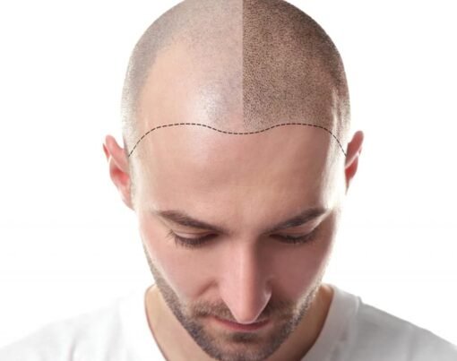 Scalp Micropigmentation