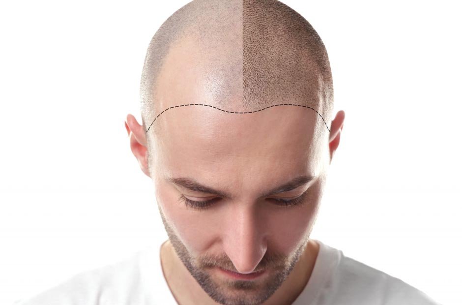 Scalp Micropigmentation