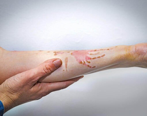 How a Burn Injury Attorney Helps Clients Seek Justice