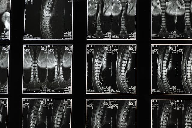 Path to Pain Relief Navigating the World of Spine Surgery